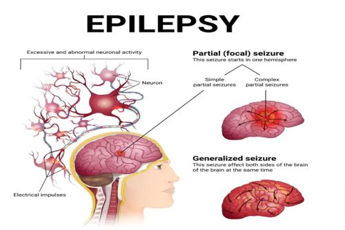 epilepsy brain neuro tissue explain