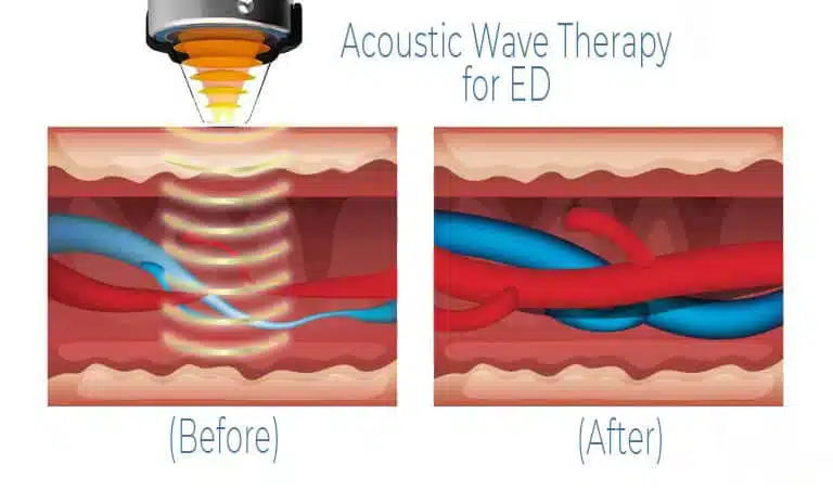 Acoustic Wave Therapy for ED In Bhandara