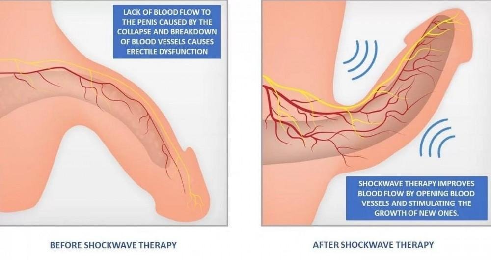 Acoustic Wave Therapy for ED in Balaghat