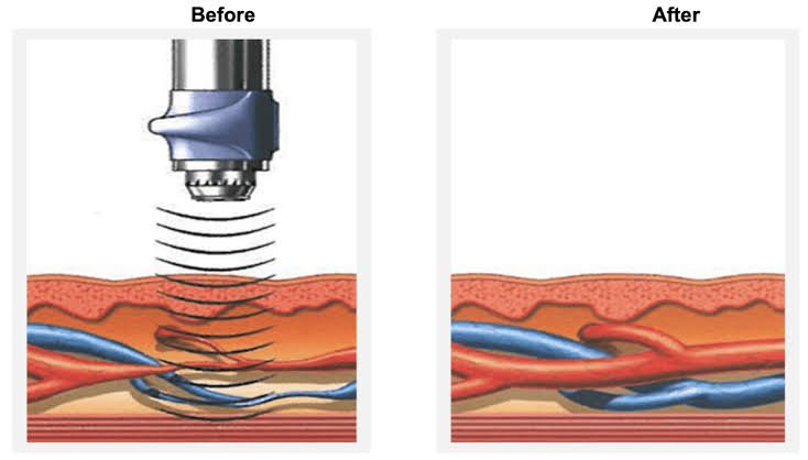 Acoustic Wave Therapy for ED in Katni