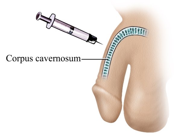 Advanced Erectile Dysfunction Treatment in Satna