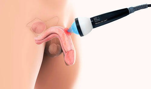 Advanced Erectile Dysfunction Treatment in Narsinghpur
