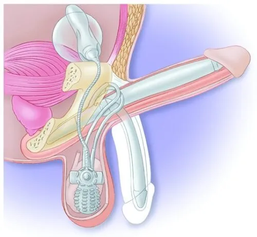 Best ED Treatment in Satna
