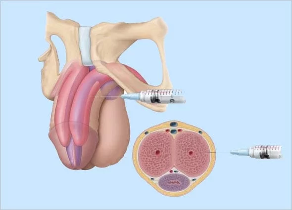 Best P Shot Clinic In Satna