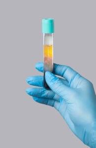 Best PRP Therapy for Men in Amravati