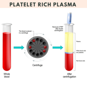 Best PRP Therapy for Men in Katni