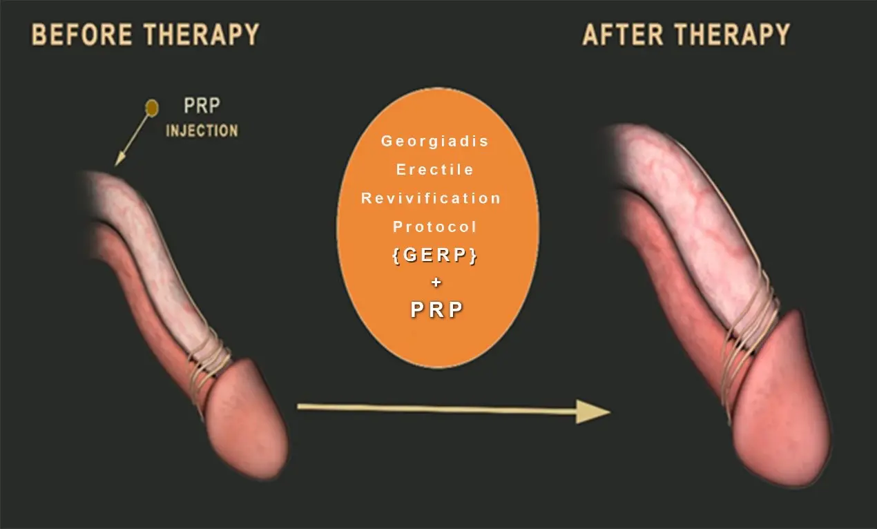 Erectile Dysfunction PRP Therapy in Nagpur