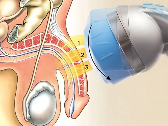 Erectile Dysfunction Shockwave Treatment in Balaghat