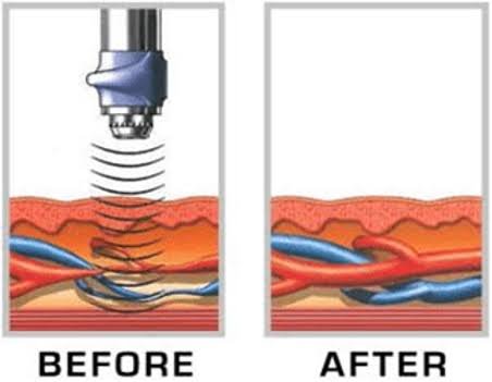 Low Intensity Shockwave Therapy