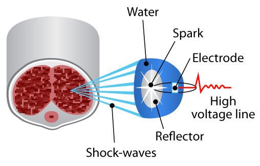 Low Intensity Shockwave Therapy In Nagpur