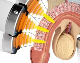 Non surgical ED Treatment in seoni