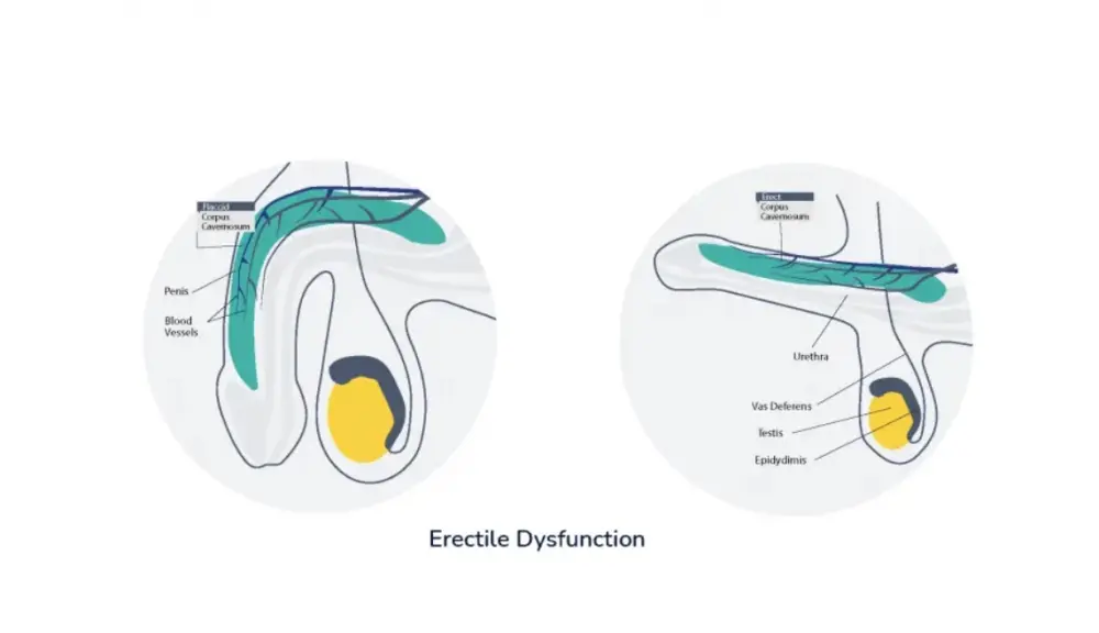 Non surgical erectile dysfunction treatment in jabalpur