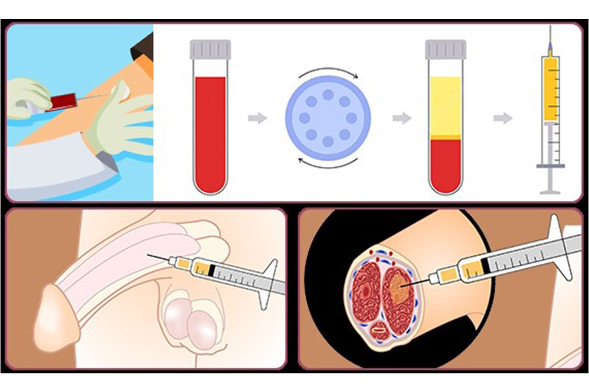 P Shot Treatment in Amravati