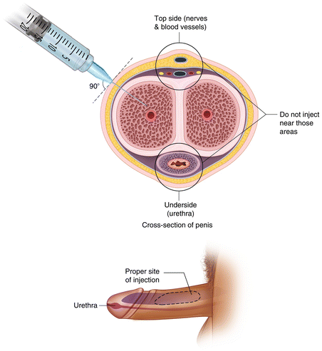 P Shot Treatment in Katni