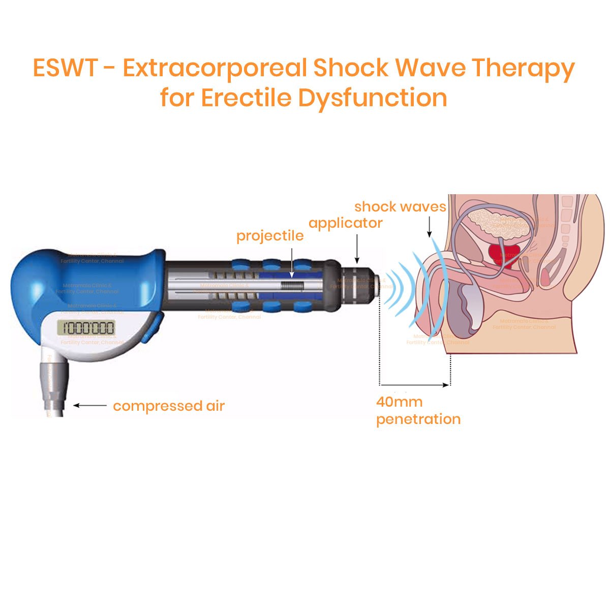 P Shot and Shockwave Therapy In Bhandara