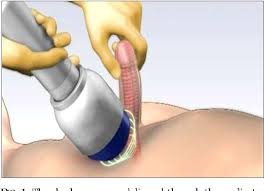 P Shot and Shockwave Therapy in Narsinghpur