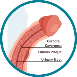 PRP Treatment for ED In Amravati