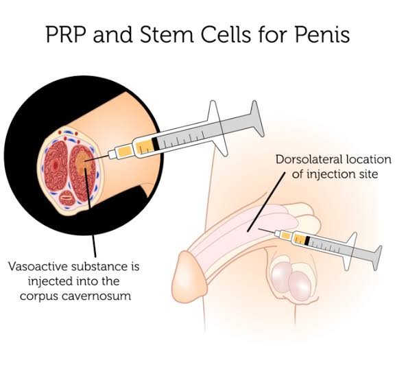PRP Treatment for ED In Katni