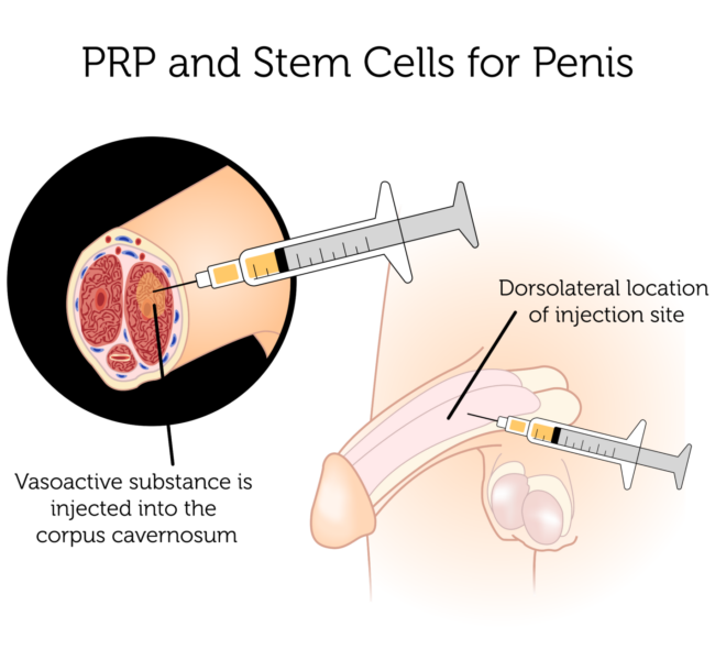 Penis PRP Therapy In Amravati