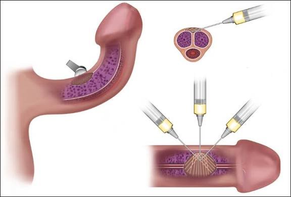 Penis PRP Therapy In Katni