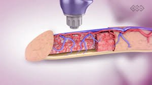 Erectile Dysfunction Shockwave Treatment in Narsinghpur