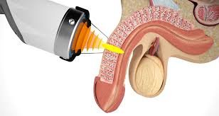 Best ED Treatment in Chhindwara