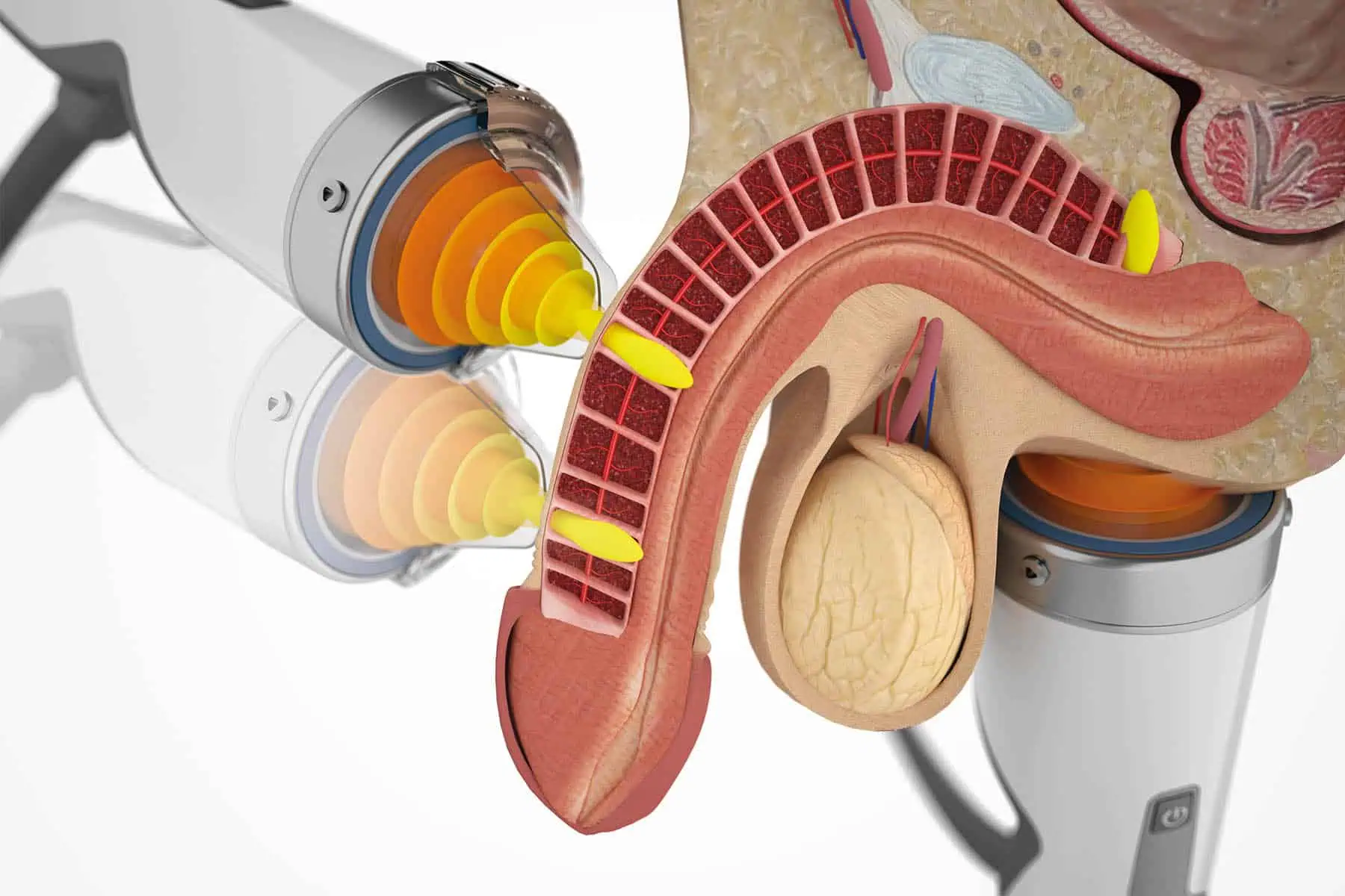 Acoustic Wave Therapy for ED in Adilabad