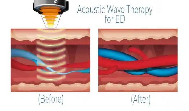 Acoustic Wave Therapy for ED in Gadarwara