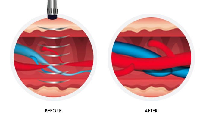 Acoustic Wave Therapy for ED in Harda