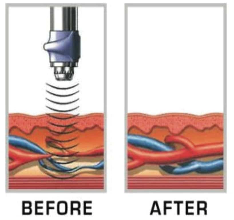 Acoustic wave therapy for ed in chandrapur