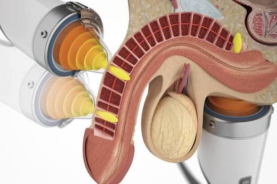 Advanced Erectile Dysfunction Treatment in Gadarwara