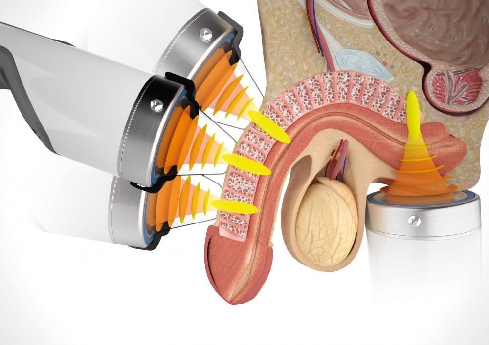 Best ED Treatment in Sagar