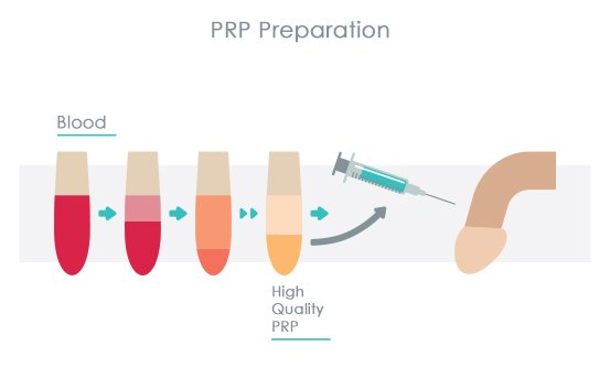 Best PRP Therapy for Men in Adilabad