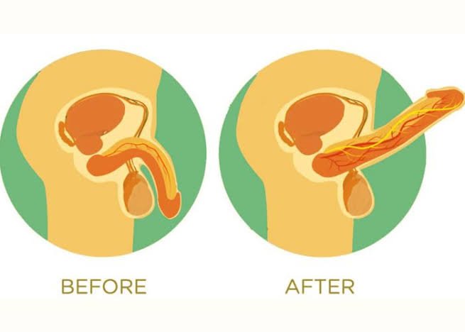 Erectile Dysfunction PRP Therapy in Bhopal