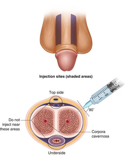 Erectile Dysfunction PRP Therapy in Yavatmal