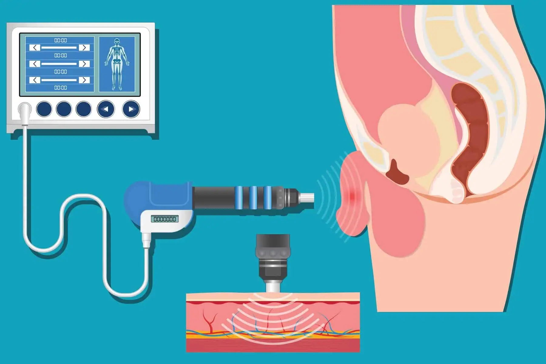 Erectile Dysfunction Shockwave Treatment in Adilabad