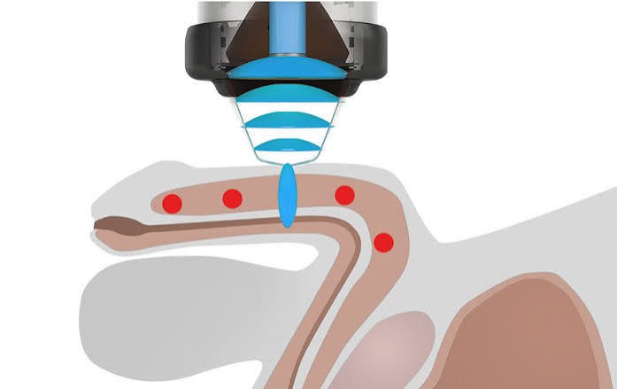 Erectile Dysfunction Shockwave Treatment in Harda