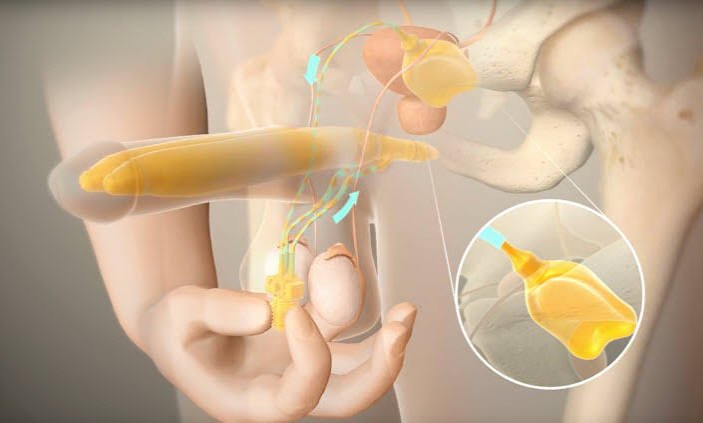 Erectile Dysfunction Shockwave Treatment in Mandla