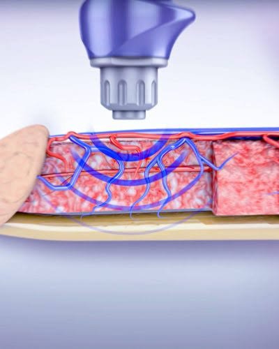 Low Intensity Shockwave Therapy in Yavatmal
