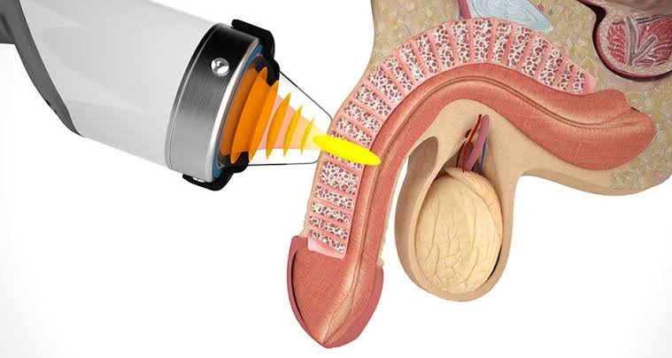 Non Surgical Erectile Dysfunction Treatment in Adilabad