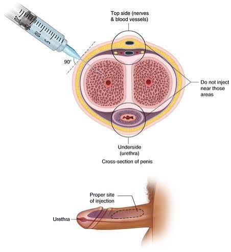 P Shot Therapy In Gadchiroli