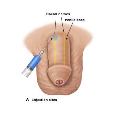 P Shot Treatment in Gadchiroli