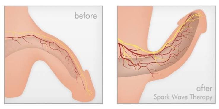 P Shot and Shockwave Therapy in Sagar