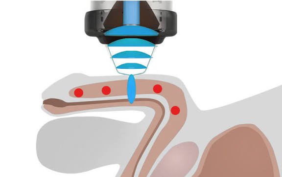 P Shot and Shockwave Therapy in Yavatmal