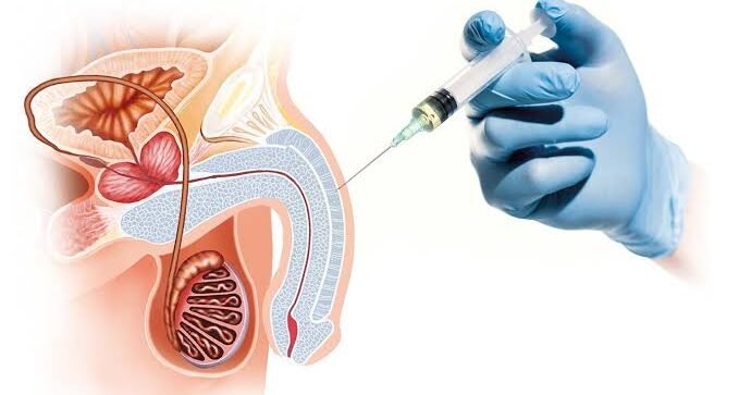 P Shot therapy In Erectile Dys
