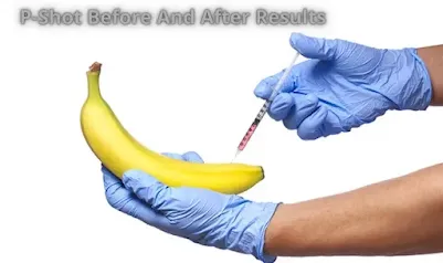 P Shot therapy in chandrapur