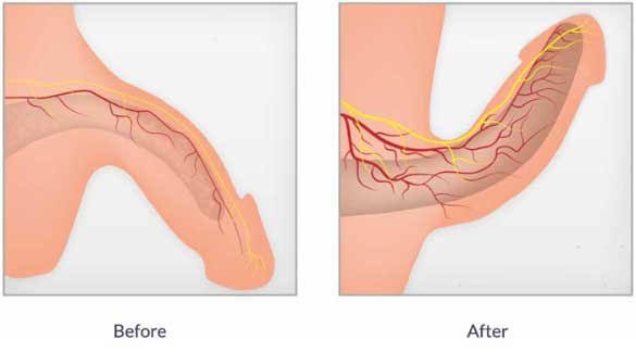PRP Treatment for ED In Yavatmal
