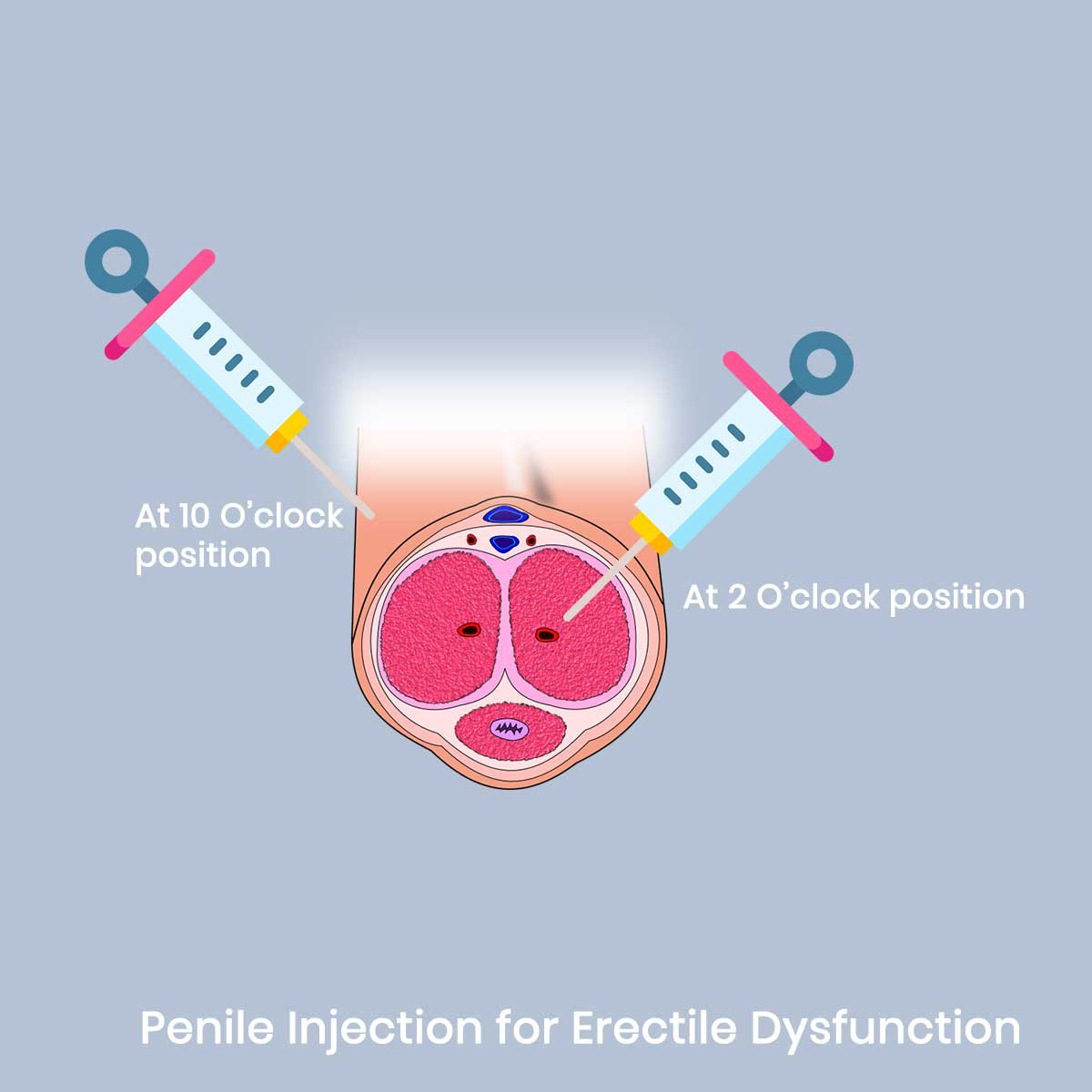 Penis PRP Therapy In Bhopal