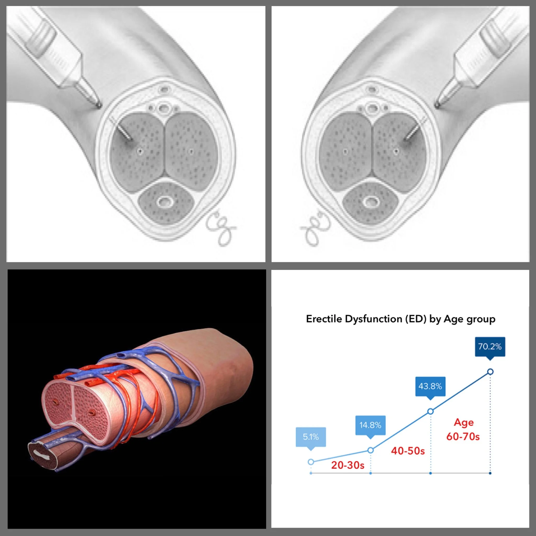Penis PRP Therapy In Mandla