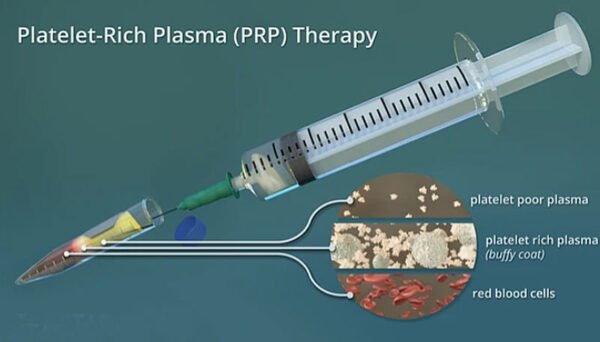 Penis PRP Therapy in shahdol